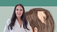 Kako se leči alopecija i od čega zavisi da li je prolazna ili hronična