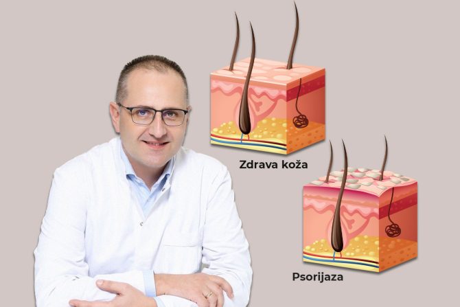 psorijaza lečenje