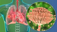 Jedna gljivica može ozbiljno da ugrozi pluća, za koje pacijente važi poseban oprez