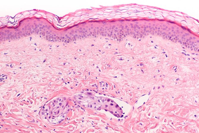 inflamatorni rak dojke