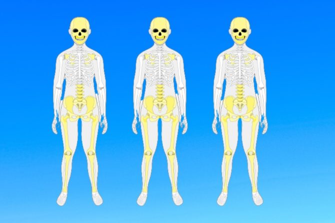 pagetova bolest kostiju