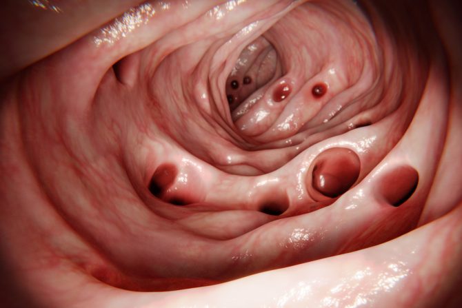 Divertikuloza i divertikulitis