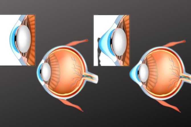 transplantacija rožnjače