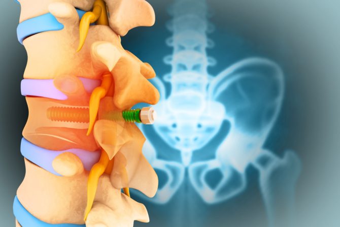 Implant u kičmenoj moždini