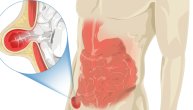 Zašto nastaje hernija, koje simptome pokazuje i kako da je sprečimo 
