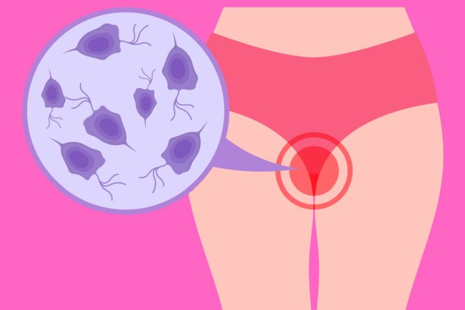vaginalne infekcije