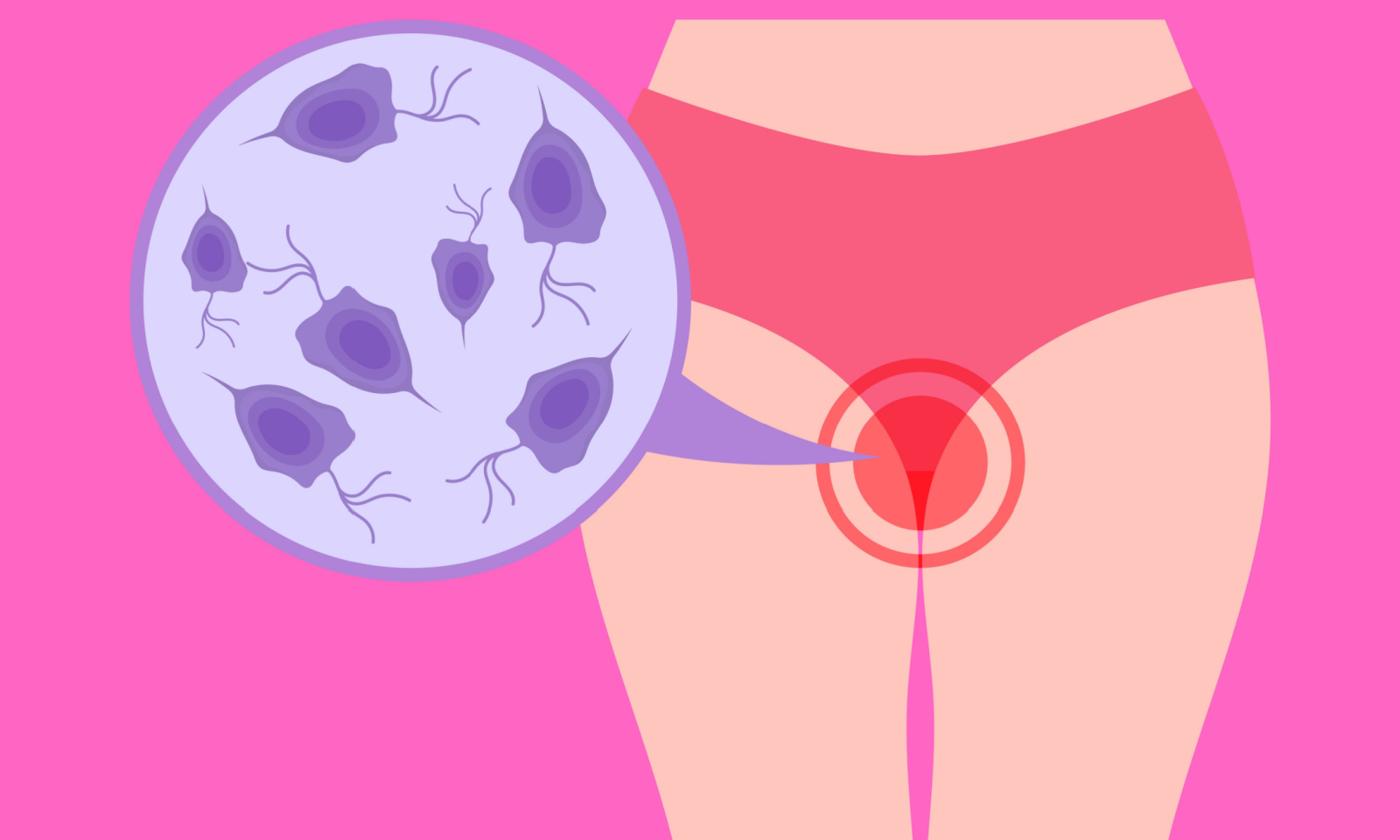 3 najee vaginalne infekcije nemaju iste simptome  kako da ih prepoznamo  i razlikujemo - eKlinika