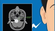 Slabljenje sluha i vrtoglavica mogu ukazati na tumor, šta je i kako se leči akustični neurom