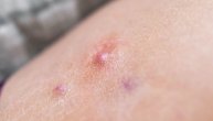 Akne ili nešto drugo? Šta je gnojni hidradenitis i kako se tretira