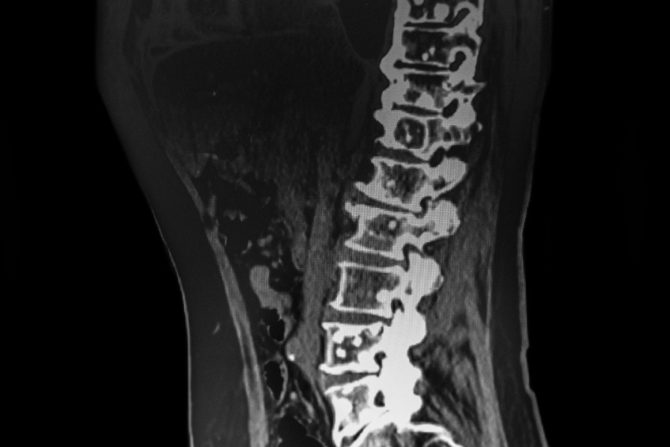 Metastaze na kostima