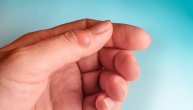 Zašto se stvara kvržica na zglobu prsta šake i koliko je opasna ova izraslina?