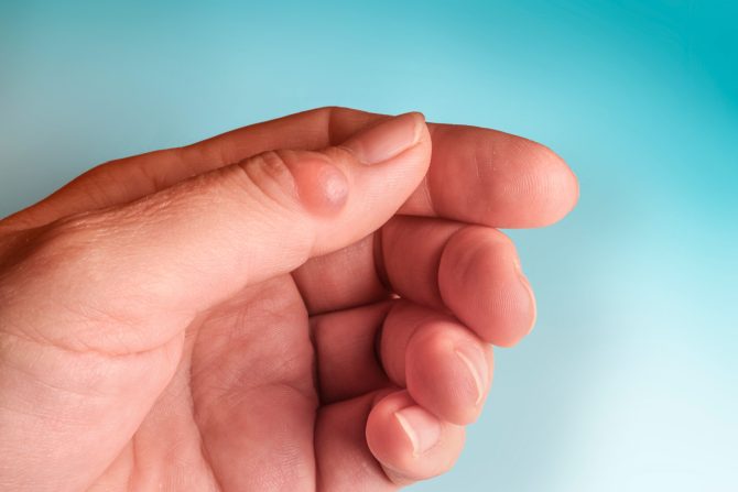 kvržica na zglobu prsta