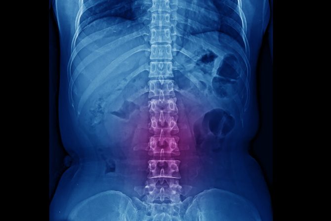 Kompresija kičmene moždine