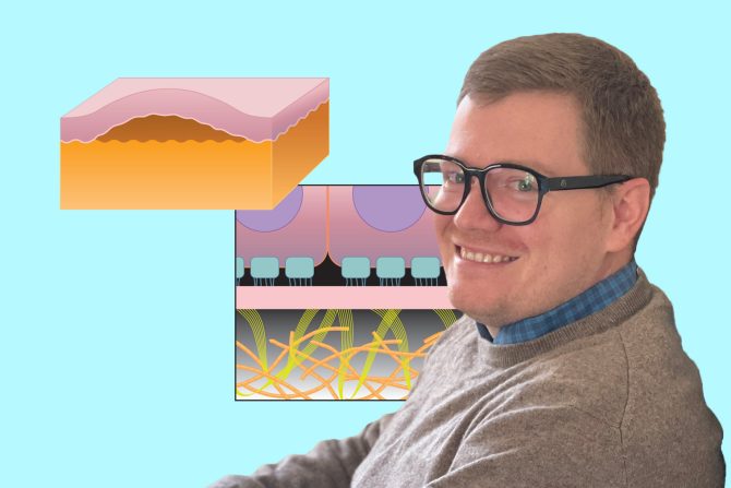 Bulozna epidermoliza