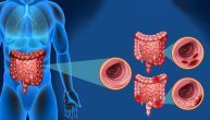 5 tipičnih simptoma koji mogu ukazati na ozbiljnu bolest creva