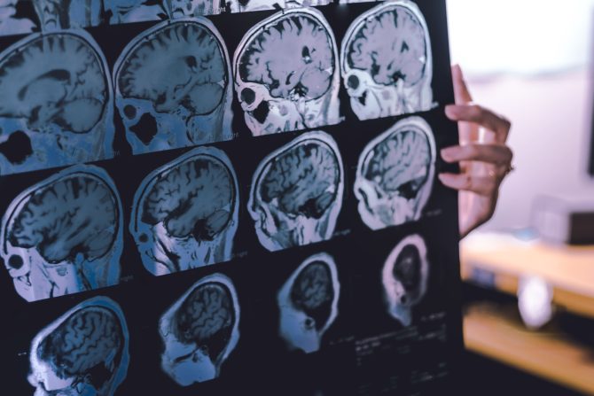 novi protein i demencija