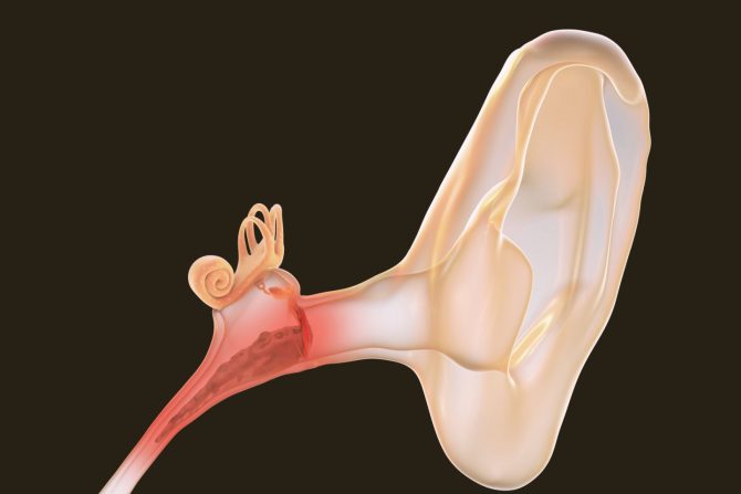 Hirurška lavirintektomija