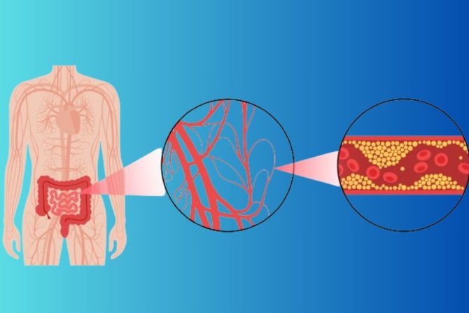 intestinalna ishemija