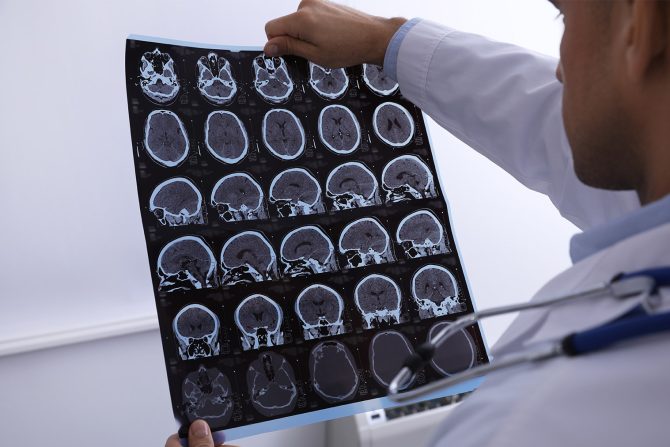 mozak magnetna rezonanca