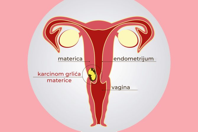 Karcinom grlića materice