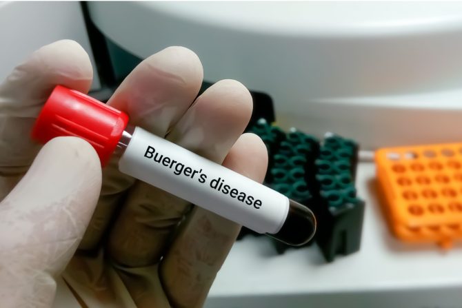 Buergerova bolest