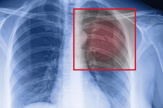 komplikacije veliki kašalj