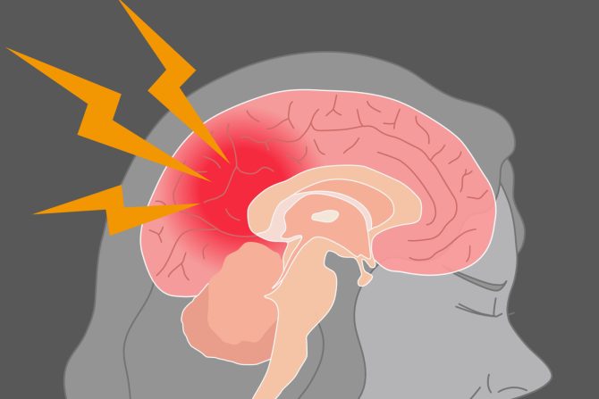 rizik od moždanog udara