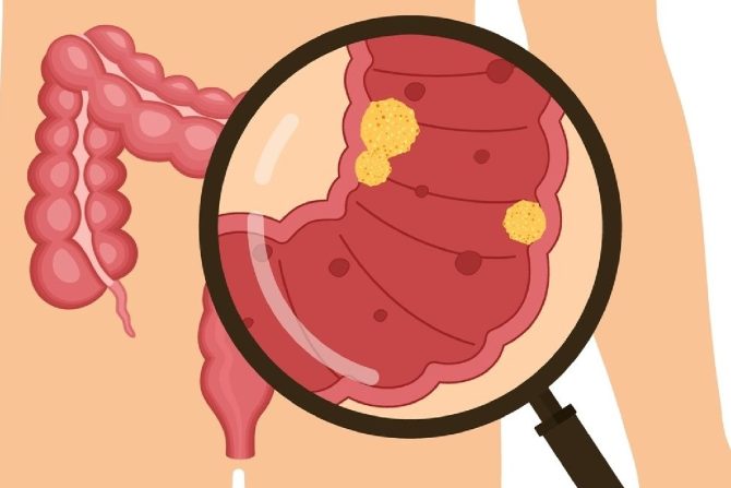 kolorektalni karcinom