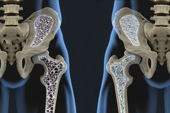 osteoporoza