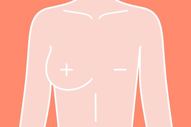 mastektomija koja smanjuje rizik