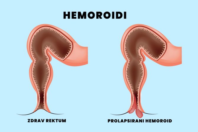 hemoroidi