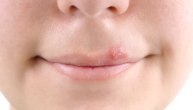 3 prirodna melema za herpes na usnama i brzo zarastanje rane
