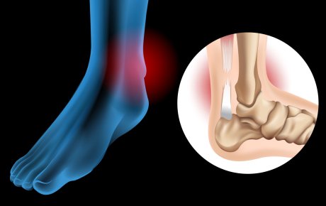 ruptura Ahilove tetive