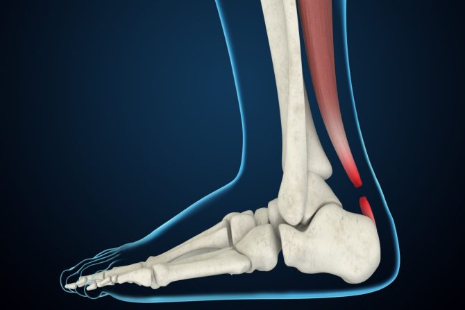 ruptura Ahilove tetive