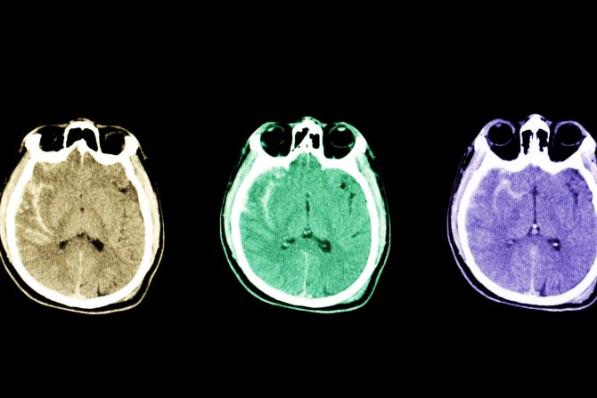 Subarahnoidalno krvarenje