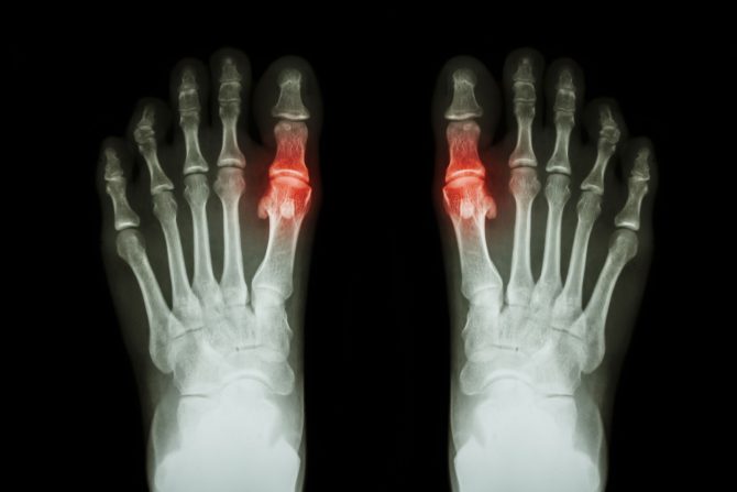 Metatarzofalangealni zglob