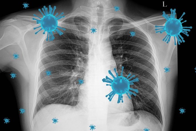 teška infekcija pluća