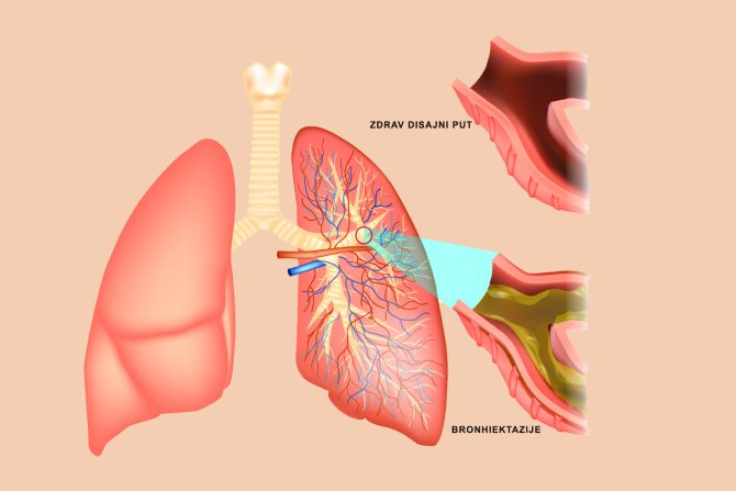 bronhiektazije