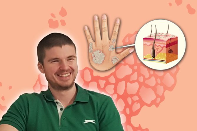 Psorijaza Marko Uzelac