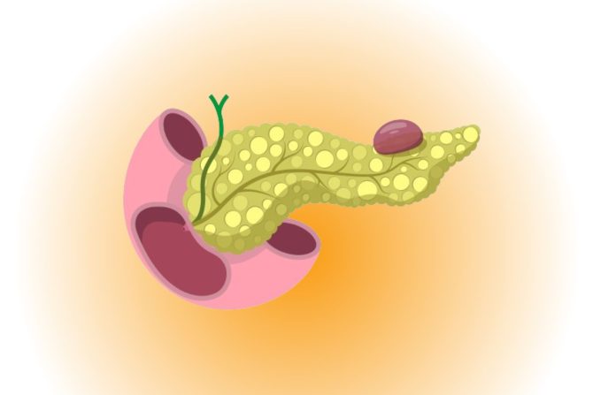 ciste pseudociste pankreas