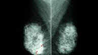 Kalcifikati u dojci su česte promene – Kada mogu biti razlog za zabrinutost