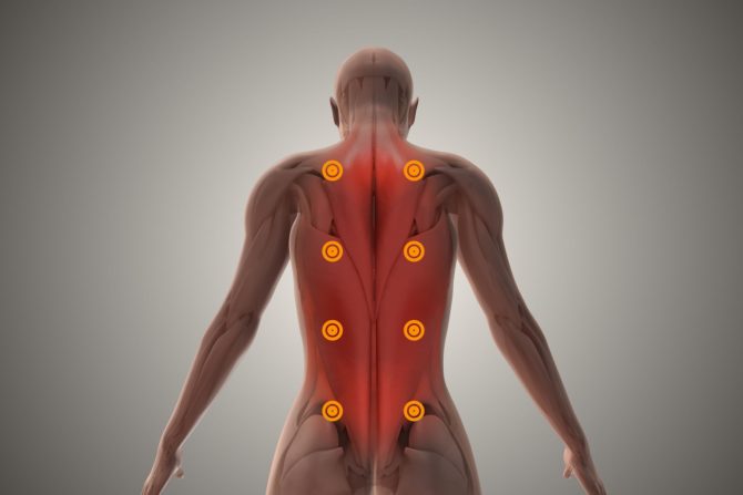 miofascijalni sindrom bola