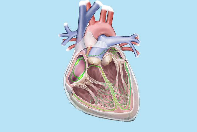 Sindrom bolesnog sinusnog čvora