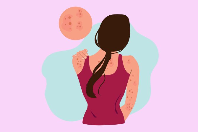 alergija na kozmetičke preparate