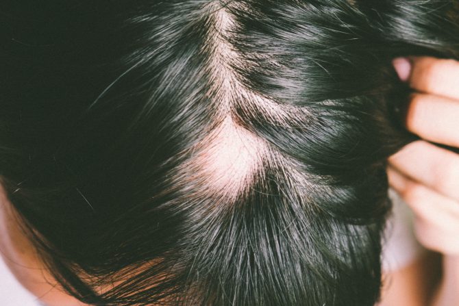 alopecija