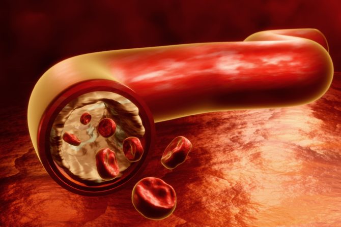 bolest perifernih arterija