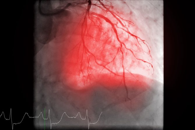 koronarrni angiogram