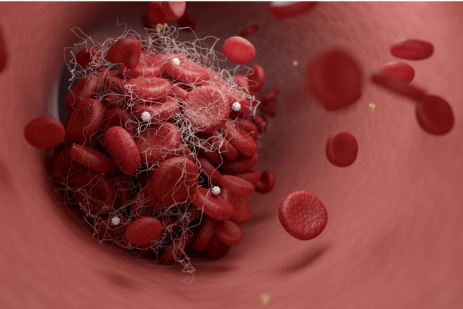 Tromb i proširene vene