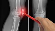 Povreda meniskusa prepoznaje se po 6 karakterističnih simptoma