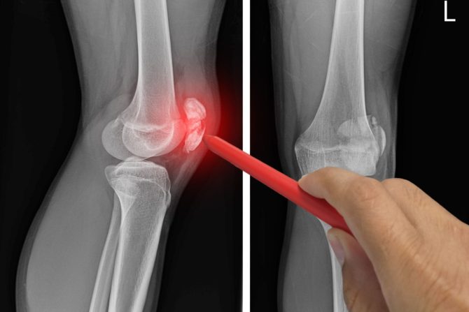 povreda meniskusa